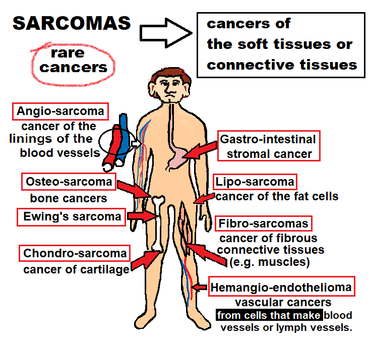 sarcomas1
